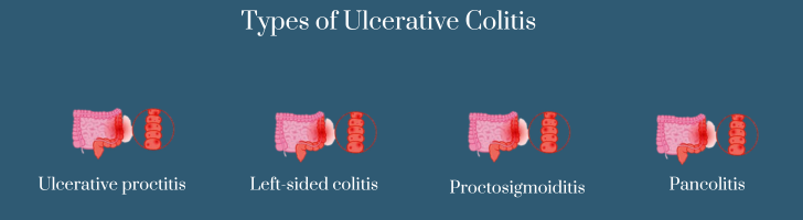 Types of Ulcerative Colitis