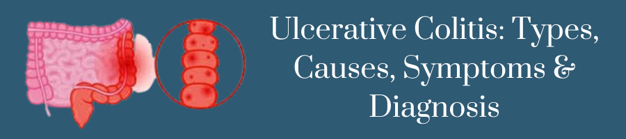 ulcerative colitis